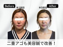 ハリユナイテッド 原宿鍼灸 整体院(HALI UNITED)/二重アゴも美容鍼で改善！