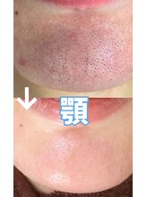 サロン リュンヌ(salon lune)/エクストラクション