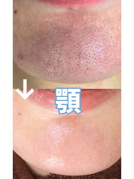 サロン リュンヌ(salon lune)/エクストラクション