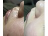 【部分Wax脱毛】気になるお顔1部分をWax脱毛で綺麗に★