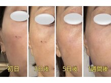 アンフィニ(Infini)/プラズマの施術後１週間★