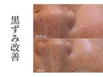 エトレ(etre)/毛穴/黒ずみ/強炭酸/ニキビケア