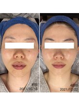 グラニット(Granit.)/フェイシャルBefore After