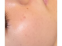 アストリア(ASTORIA)/艶玉艶肌（30代）加工なし素肌