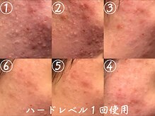 クレアナ ザ ビューティー(KULEANA the beauty)/ハーブピーリング