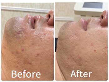 ジョアアンジェ 京橋店(joie ange)/ニキビケア＆毛穴レス肌！