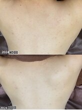 フルール(Fleur)/■背中トリートメント■