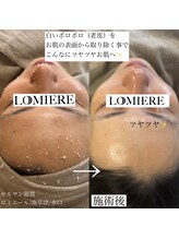 ロミエール 南草津店(LOMIERE)/セルマン★角質整理