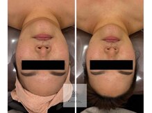 レミュ(Remu)/脂肪燃焼液5ml