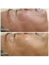 エース(ACE.)/赤み改善&トーンアップ☆