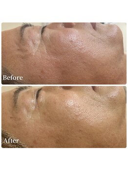 エース(ACE.)/赤み改善&トーンアップ☆