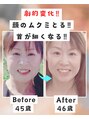 ヨサパークビーンズ 上本町店(YOSA PARK BEANS。) LULUON週2+ハッピーバス毎入浴+水素水毎日飲むで顔シュッと1年
