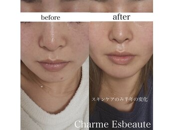 シャルム エスボーテ(charme Esbeaute)/スキンケア半年使用