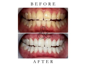 ジュエルホワイトニング/ホワイトニングビフォーアフター