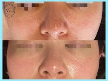 ハーブピーリング 名古屋/LALAピール