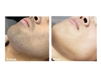 スターチス(Statice)/お髭脱毛ビフォーアフター