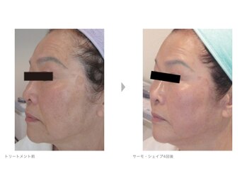 Nビューティー/最新RFサーモシェイプオーパス