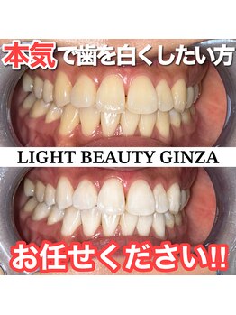 ライトビューティー 銀座店(LightBeauty)/東銀座　ホワイトニング症例写真