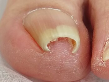 重く痛い巻き爪も一回で