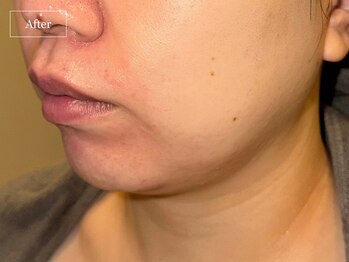 キュレイテッドスキン(CURATED SKIN)/レモンボトル/脂肪分解美容液