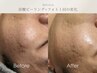 【 皮脂&メンズニキビ 】最新マシンで毛穴洗浄+炭酸ハーブ+ニキビ集中ケア◎