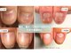 リケアネイル(Re:care nail)の写真