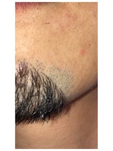 メンズ脱毛 リボーン(reborn)/施術の境目