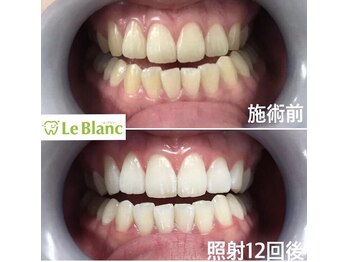 ルブラン 奈良店(Le Blanc)/褒められる歯に！！