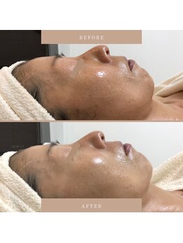 ブリス(Bliss)/ACトリートメント 