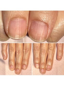 ココデネイル(cocode nail)/お悩み:短い爪(20代後半)