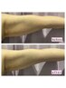 ☆痩身☆　二の腕orふくらはぎ4000ショット　￥6,600→￥4,000