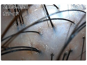 エルール トータルビューティ(Aileure total beauty)/育毛促進ケア　