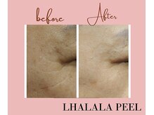 エンジェライト(Angelicht)/Before→After