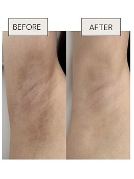 ミイン(美in)/ローマピンク　脇