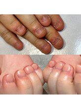 ティアラネイル 宇都宮/深爪矯正