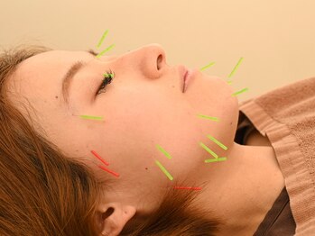 三和旭が丘院/八王子の美容鍼施術