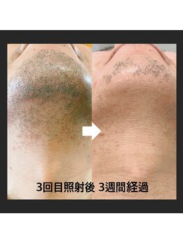 サンスタイルクリア 守山店(SUN STYLE CLEAR)の写真/メンズも脱毛でケアする時代★痛みの少ない最新脱毛で清潔感UPのモテ肌へ！リラックスできる完全個室完備
