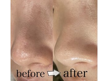 ウイ 津幡店(Ui)/毛穴洗浄