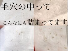 シュリ(Shri)/毛穴エクストラクション