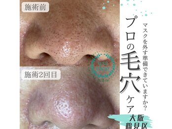 リッカロッカ(RIKKA&ROCCA)/毛穴が小さくなってきました