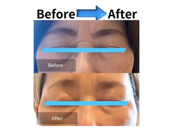 ラシェリー(La Cherie)/ビフォーアフター施術1回