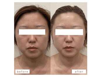 ラキネイ 目黒(Lakinei)/≪テラボーラーの効果≫