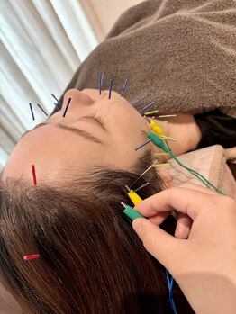 クマノミ美容鍼灸 銀座院(KUMANOMI美容鍼灸)/頭から小さく！小顔矯正も対応