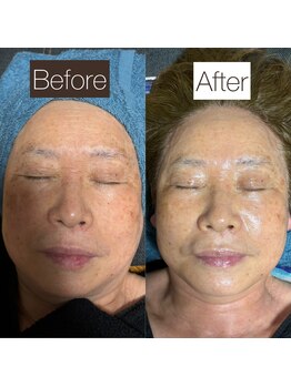 東京デトックス/60代後半女性。レチノールF90分