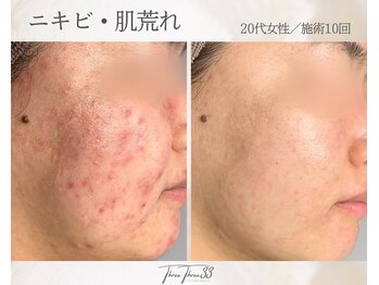 スリースリー(THREE THREE)/ニキビ・肌荒れ