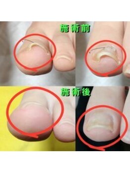 【巻き爪】ネイル/フット