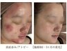肌バリア徹底強化！花粉荒れ×ゆらぎ肌改善【敏感、乾燥、赤みの方】