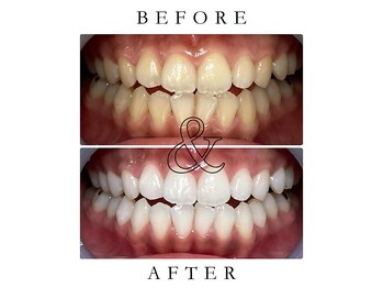 ジュエルホワイトニング/ホワイトニングビフォーアフター