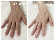 キレイテ 福岡天神店/血色の悪さ・血管の浮き