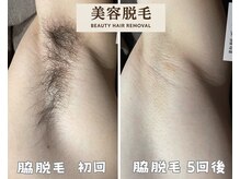 シエルエトワール 唐津店(Ciel Etoile)/美容脱毛　ワキ脱毛